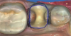 Fig 8. For a preparation dubbed a “crownlay,” with complete cuspal reduction on the tooth.