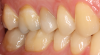 Fig 11. A crown was placed on tooth No. 4.
