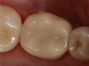 Fig 1. A CAD/CAM crown restoration after coming out of the milling unit.