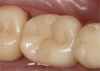 Fig 2. A CAD/CAM crown restoration after coming out of the milling unit with the addition of anatomic accentuation.