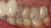 Fig 5. Teeth Nos. 13, 14, and 15 are not crowns.