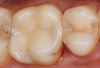 Fig 6. A two-surface inlay on an upper first molar.