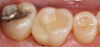 Fig 7. An onlay on an upper first molar.