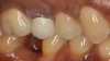 Fig 10. A patient was unhappy with the appearance of a PFM crown.