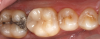 Fig 12. An onlay was placed on tooth No. 30.