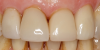 Fig 16. Two cases in which tooth No. 9 was restored.