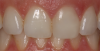 Fig 17. Two cases in which tooth No. 9 was restored.