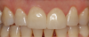 Fig 18. Two cases in which teeth Nos. 8 and 9 were restored.