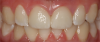 Fig 19. Two cases in which teeth Nos. 8 and 9 were restored.