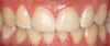 Fig 20. Two cases of complete-coverage crowns for teeth Nos. 8 and 9.