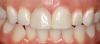 Fig 21. Two cases of complete-coverage crowns for teeth Nos. 8 and 9.