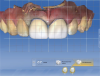 Fig 23. Design for crowns on teeth Nos. 8 and 9.