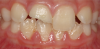 Fig 27. A pediatric patient presented with a fractured central incisor, tooth No. 8.