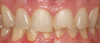 Fig 28. A patient presented with a large composite filling on tooth No. 9 that had failed or fractured.