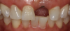 Fig 31. An implant was placed by a periodontist.