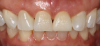 Fig 32. The clinician scribed in some of the texturing seen on tooth No. 8 onto tooth No. 9.