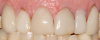 Fig 33. A patient presented with failing veneers.