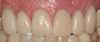 Fig 34. Final result with complete-coverage crowns.