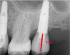 Fig. 1. Occlusal table to platform.