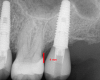 Fig 6. The contact area should start within 4 mm of the crest of the bone between the two teeth.