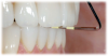 Fig 4. Beware if change in overjet is greater than change in overbite.