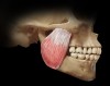 Fig 5. Masseter muscle.