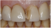 Figure 1 A patient presented with a fractured veneer on tooth No. 9.