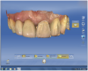 Figure 3 A copy line was drawn on the preoperative scan of tooth No. 9, which included the entire surface, line angles, and incisal edges.