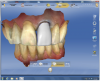 Figure 12 The software proposed a restoration of exactly the same form, shape, and size of tooth No. 8.