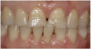 Figure 14 View of the patient’s fractured incisal edges on teeth No. 8 and No. 9, with wear and diastemas between them.