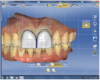 Figure 17 Several tools, including a grid to verify restoration symmetry, were utilized to modify the shape and form of the veneers.