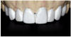 Figure 20 The laboratory fabricated an ideal wax-up with golden proportions.