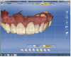 Figure 22 After cementation, the eight provisionalized teeth were scanned.