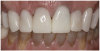 Figure 24 Close-up retracted view of the completed CAD/CAM crown restorations following adhesive cementation.