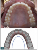 Fig 1. “U” arch shape.