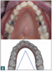 Fig 2. “V” shape (improper).