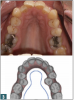 Fig 3. “Omega” shape (improper).