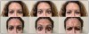 Fig 1. Moderate to severe horizontal forehead wrinkles (bottom center), frown lines (bottom right), and the patient at rest (bottom left) before treatment. Top row shows the same views after 7 days of Botox treatment. (Actual patient; results may vary.)