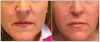 Fig 9. Dermal fillers before (left) and after treatment (right) for the lower half of the face.