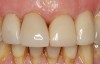 The veneer was seated using dental adhesive and resin cement.