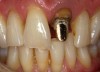 A patient presented with a fractured porcelain crown on tooth No. 9.