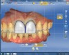 Several tools, including a grid to verify restoration symmetry, were utilized to modify the shape and form of the veneers.