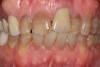 A patient presented with an uneven smile, discolored teeth, and insufficient tooth display when smiling.