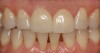 View of the restorations after adhesive resin cementation.