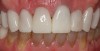 Close-up retracted view of the completed CAD/CAM crown restorations following adhesive cementation.